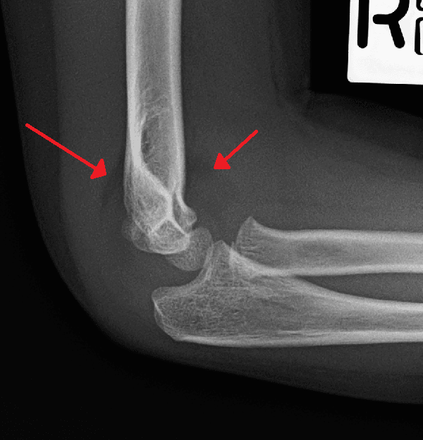 Lateral paediatric elbow radiograph showing anterior (sail) and posterior fat pad signs