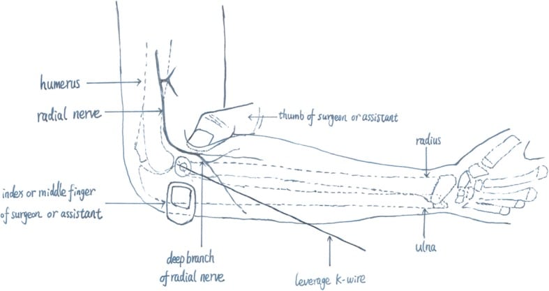 Line drawing of leverage K-wire reduction at the elbow, labelling the humerus, radius, ulna, radial nerve and its deep branch, the leverage K-wire, the thumb of the surgeon or assistant, and the index or middle finger of the surgeon or assistant.