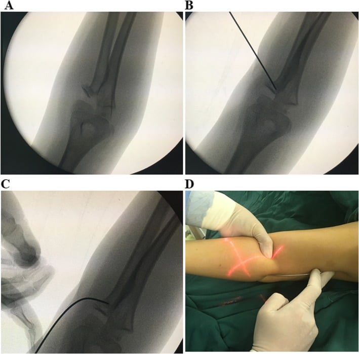 Four-panel figure: (A) fluoroscopy of a radial neck fracture; (B) a straight wire introduced to the fracture; (C) a curved wire at the proximal radius on a further fluoroscopic view; (D) the operative field with gloved hands at the elbow and a wire in place.