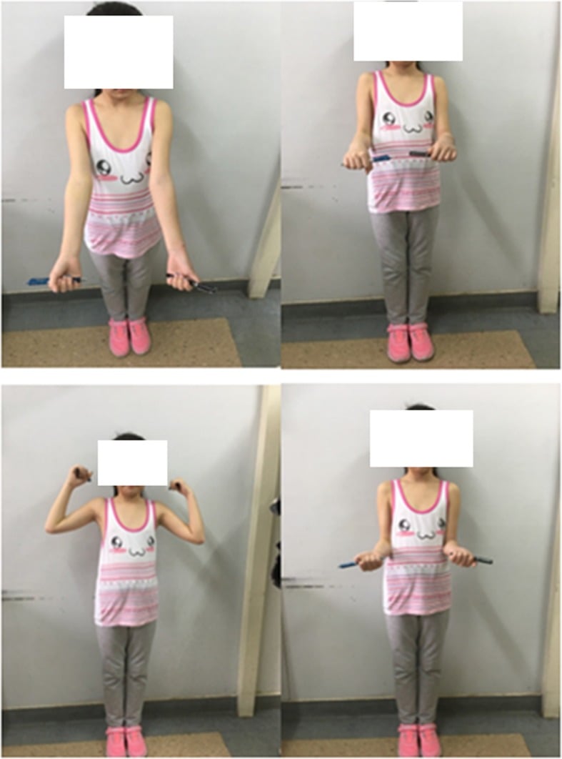Four clinical photographs of a child, face obscured, holding a pen in each hand with the arms in four different positions.