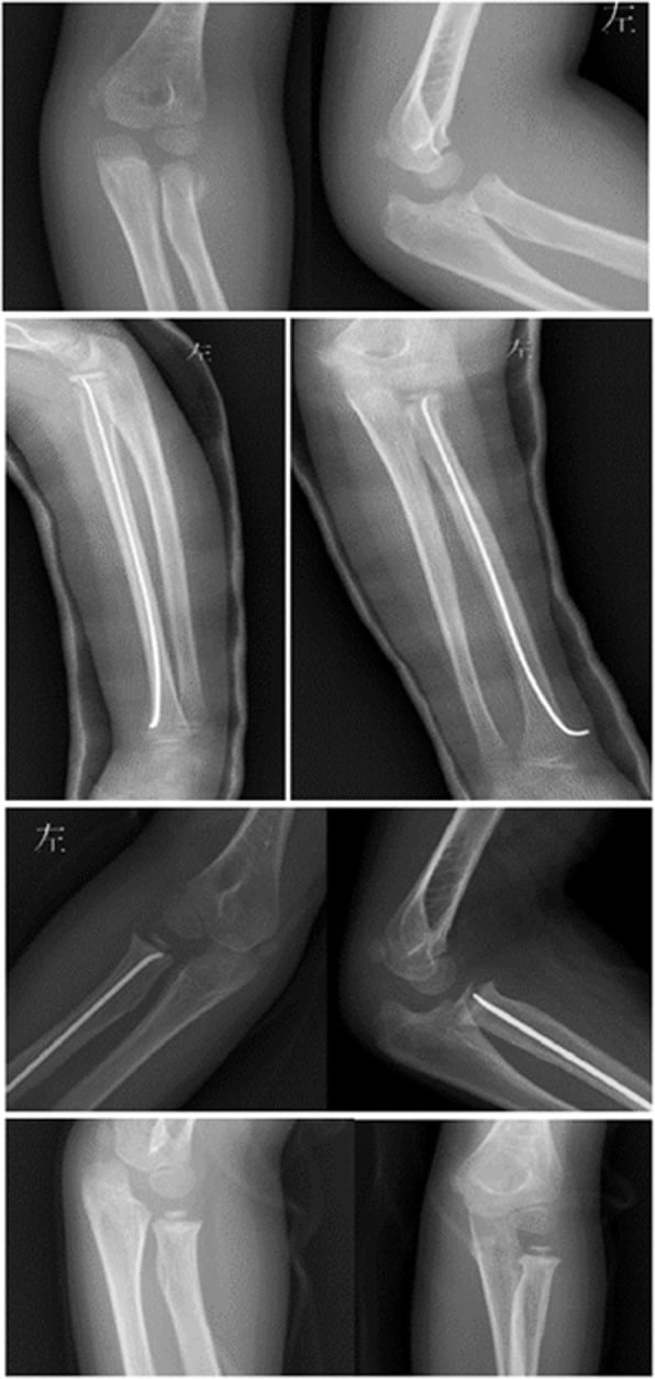 Four rows of paired radiographs: the radial neck fracture, an elastic nail passed up the radius from its distal end, the head held on the nail at the elbow, and later elbow views without the nail.