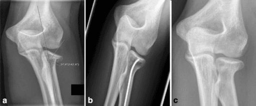 Paediatric elbow radiographs showing an angulated radial neck fracture with the angulation measured, plus follow-up views.