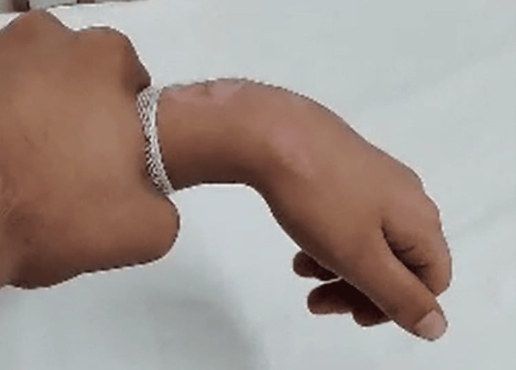 Clinical wrist-drop posture after radial nerve palsy