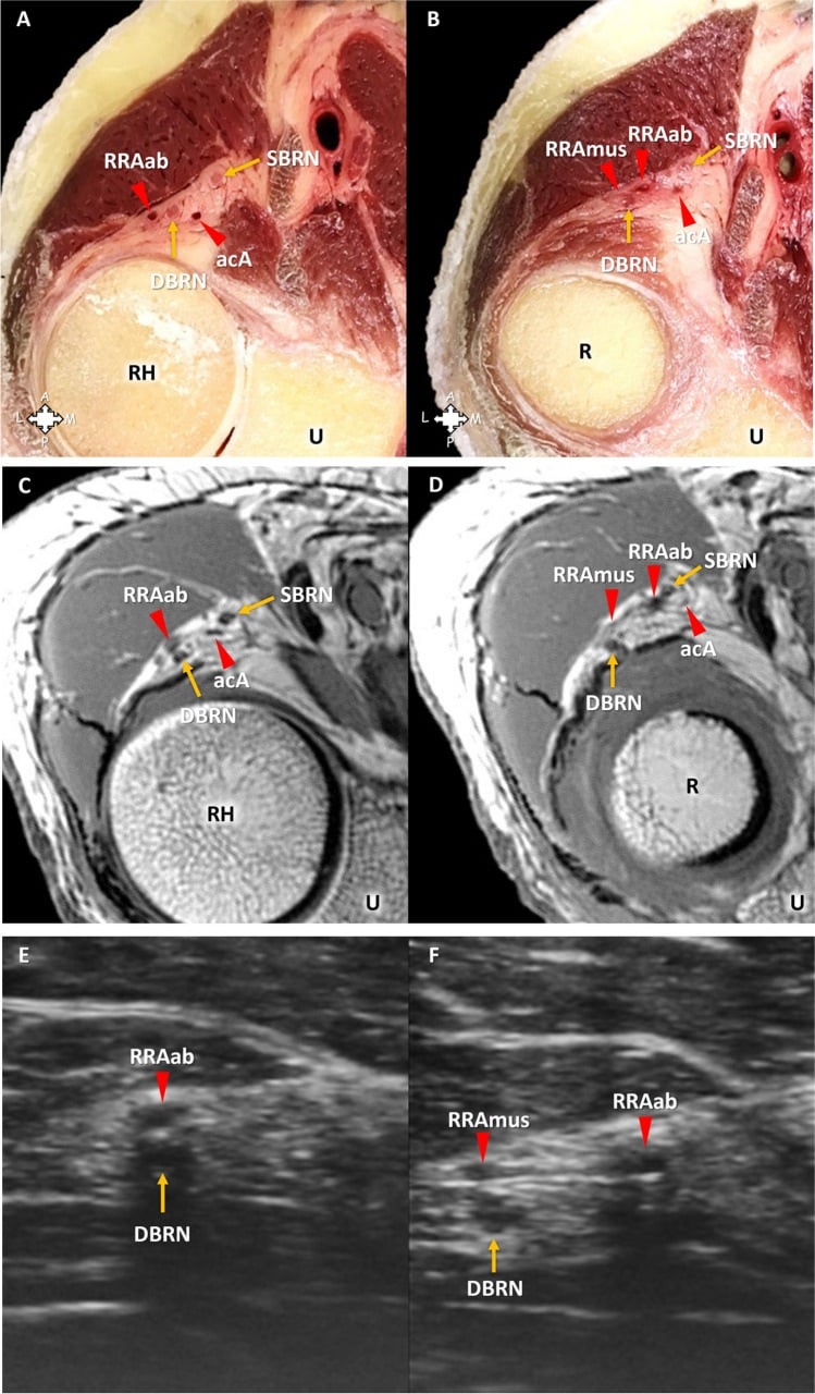 Leash of Henry relationship to the deep radial nerve on dissection MRI and ultrasound