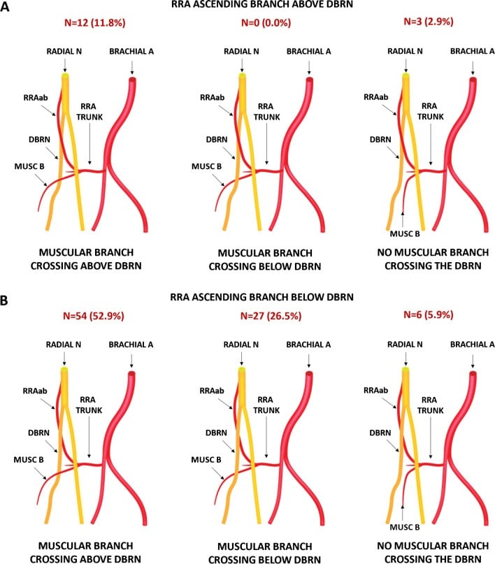 Anatomical crossing patterns of the leash of Henry over and under the deep radial nerve