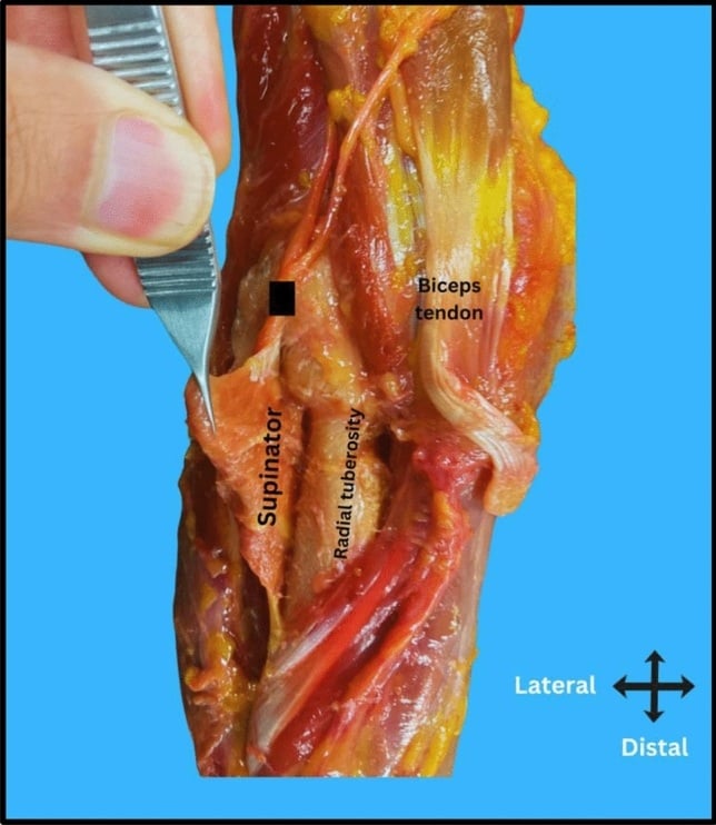 Posterior interosseous nerve protected between the superficial and deep heads of supinator