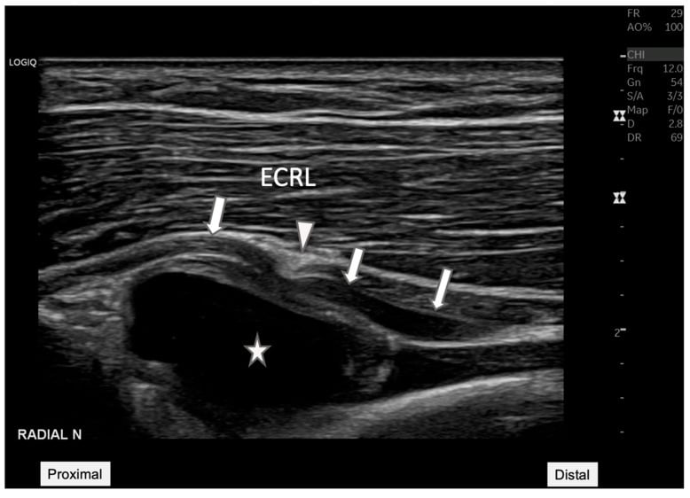 Long-axis ultrasound showing PIN entrapment at the arcade of Frohse by a synovial cyst