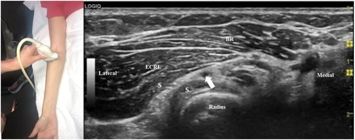 Ultrasound of the motor branch entering the arcade of Frohse