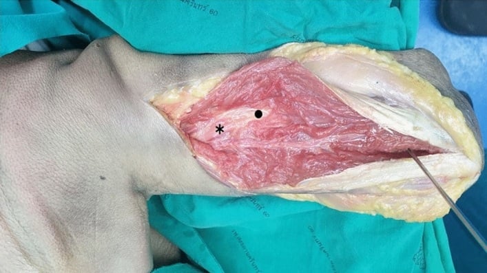 Posterior humerus showing the radial nerve in the groove and at the lateral intermuscular septum
