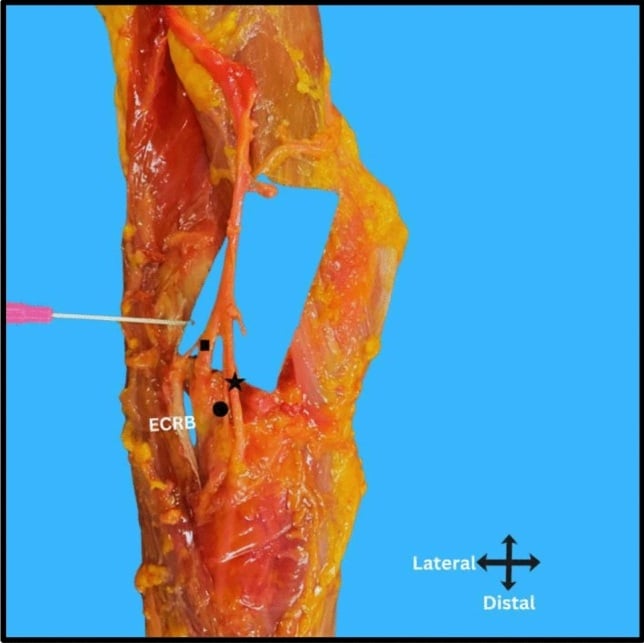 Cadaveric radial nerve bifurcation at the radiocapitellar joint