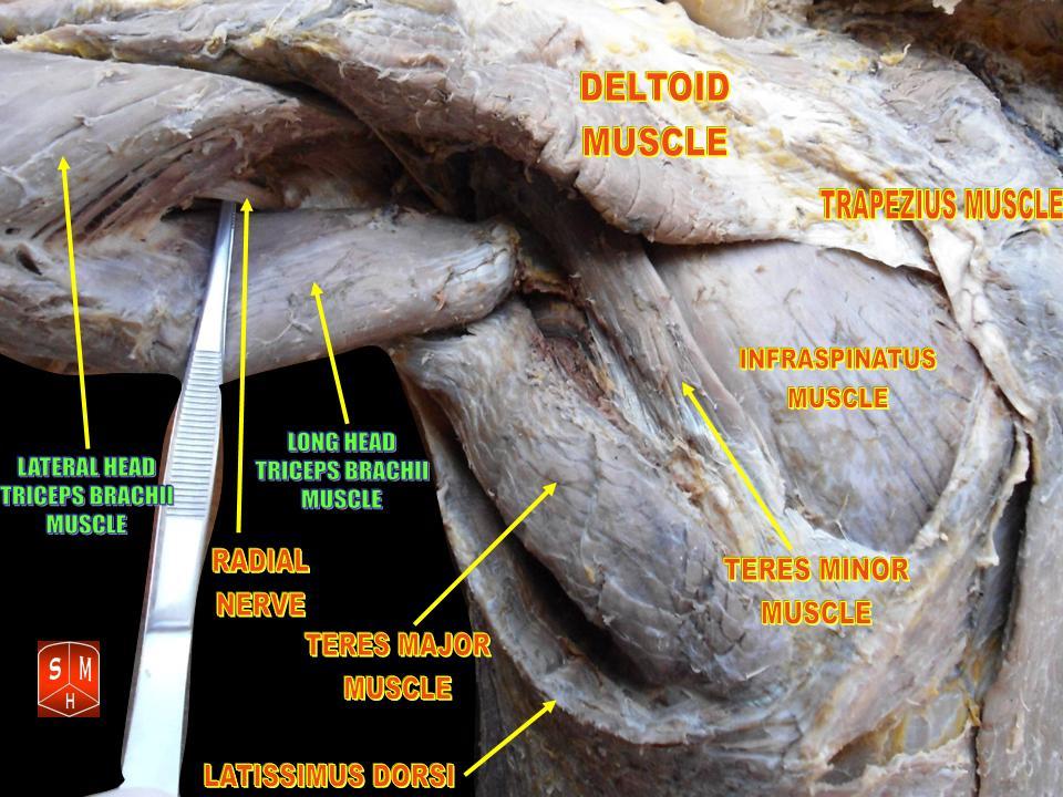 Cadaveric dissection of the posterior shoulder and arm showing the radial nerve between the heads of triceps