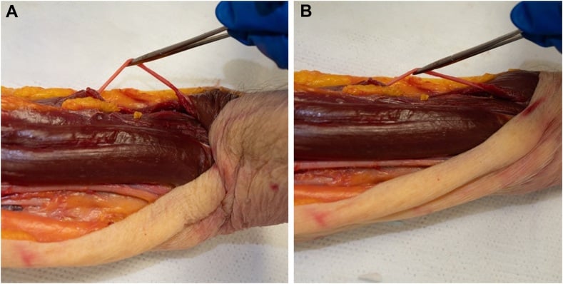 Radial nerve after leaving the spiral groove in elbow flexion and extension