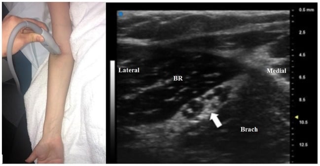 Ultra-high-frequency ultrasound showing fascicular organisation before radial-nerve bifurcation