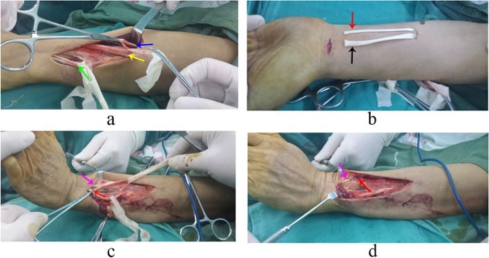 Stepwise tendon transfers for irreversible radial nerve palsy