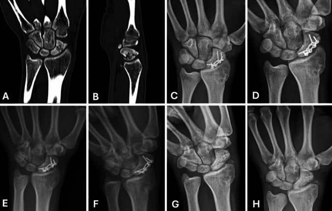 CT and radiographs of an acute scaphoid waist fracture treated with a volar plate, including preoperative coronal CT, immediate postoperative films and 12-month union films.