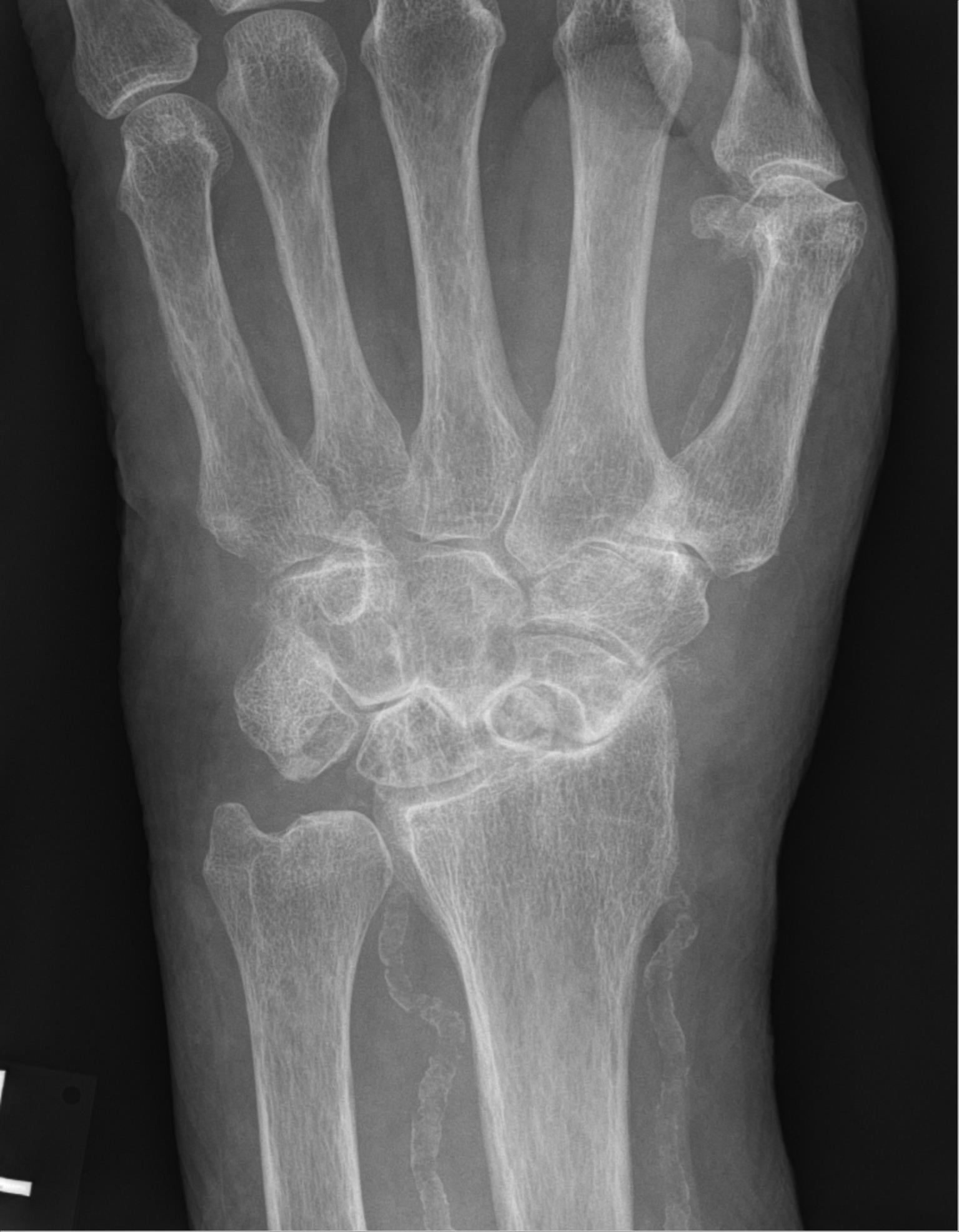 Anteroposterior radiograph of a wrist showing scaphoid non-union with radioscaphoid arthritis and a preserved midcarpal joint.