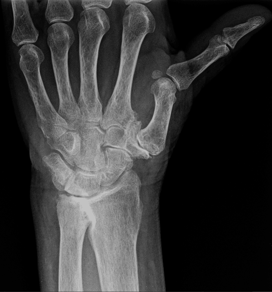 Radiograph of a thumb showing trapeziometacarpal osteoarthritis with adduction and metacarpophalangeal hyperextension, plus distal radioulnar osteoarthritis.