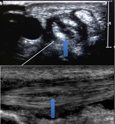 Short-axis and long-axis ultrasound of the first extensor compartment showing a longitudinal split in extensor pollicis brevis.