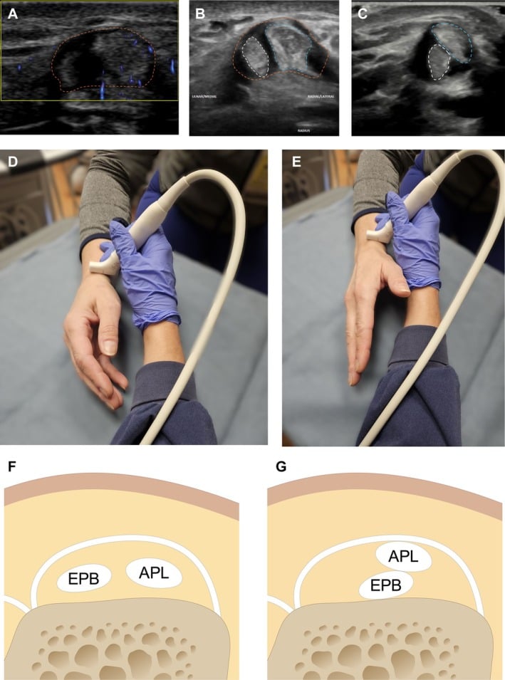 Short-axis ultrasound of the first extensor compartment showing APL and EPB tendons inside a thickened sheath, with a schematic of tendon subluxation.