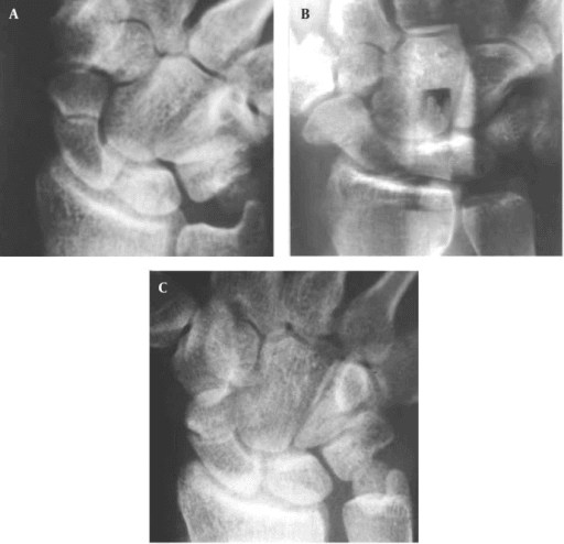 Conventional and panoramic wrist radiographs assessing scaphoid fracture union ten weeks after injury