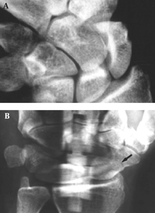 Paired conventional and panoramic wrist radiographs one week after acute trauma