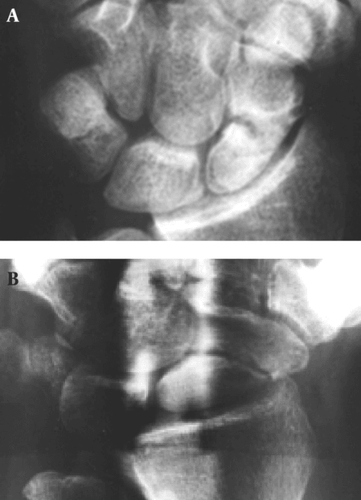 Paired wrist radiographs, conventional and panoramic, of a young man four months after injury