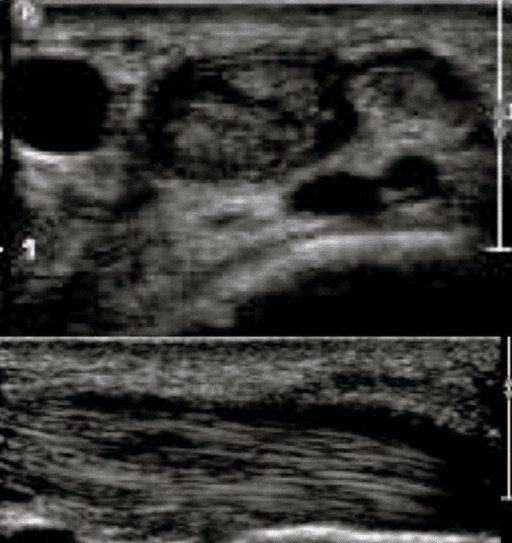 Follow-up ultrasound scan of the first extensor compartment showing a healing tendon split