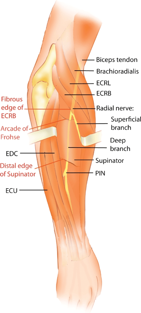 Dorsal-approach illustration of the radial tunnel showing the radial nerve dividing into superficial and deep branches, the deep branch becoming the posterior interosseous nerve, with the fibrous edge of ECRB, arcade of Frohse and distal supinator edge labelled.