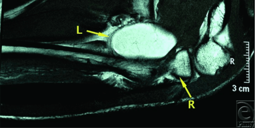 Axial T2-weighted MRI of the proximal forearm showing a well-defined high-signal space-occupying lesion in the radial tunnel adjacent to the proximal radius.