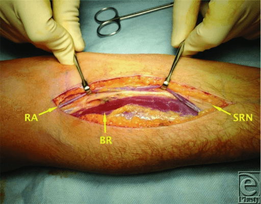 Intra-operative photograph of the anterior approach to posterior interosseous nerve decompression at the superficial-dissection stage, with brachioradialis, radial artery and superficial radial nerve labelled.