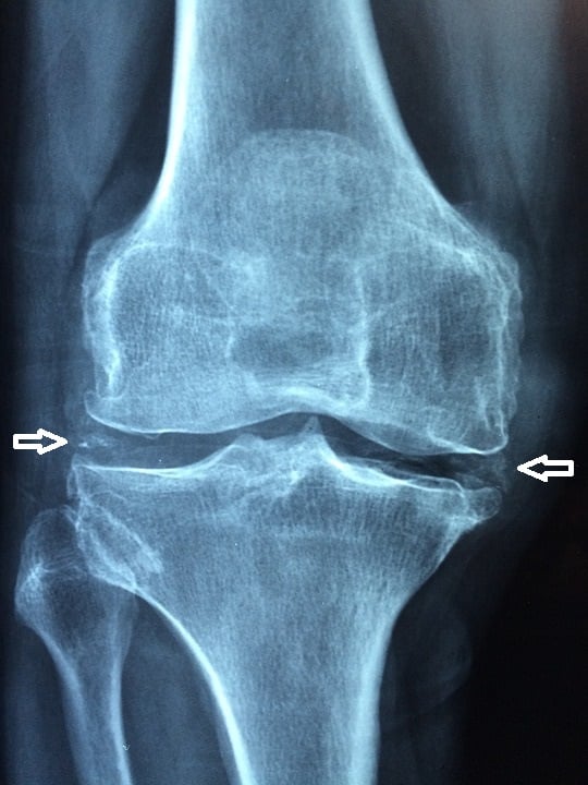 AP knee radiograph with arrows indicating chondrocalcinosis - linear calcification within the menisci indicating calcium pyrophosphate crystal deposition