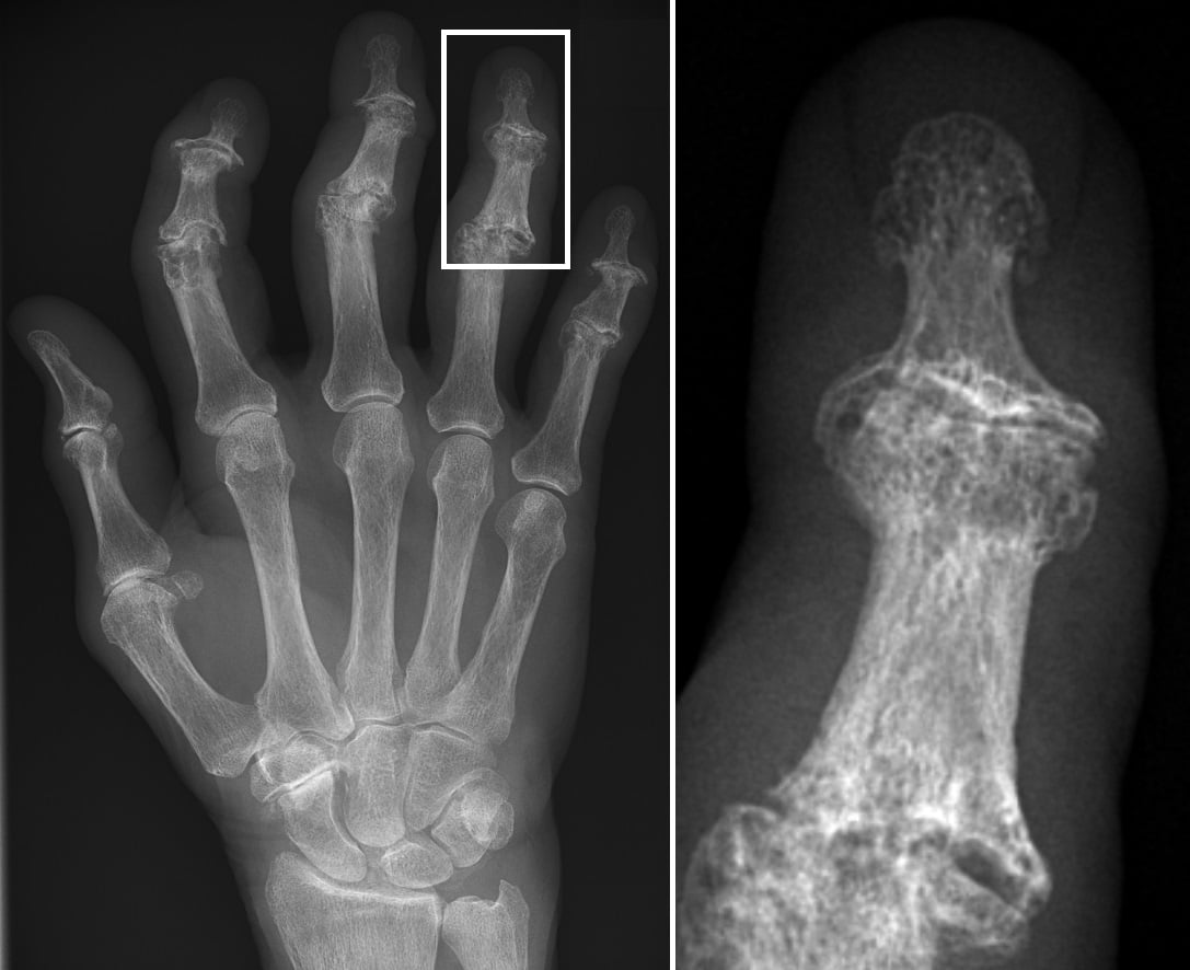 Hand radiograph demonstrating erosive osteoarthritis with classic gull-wing appearance at DIP joints showing central erosions and marginal osteophytes