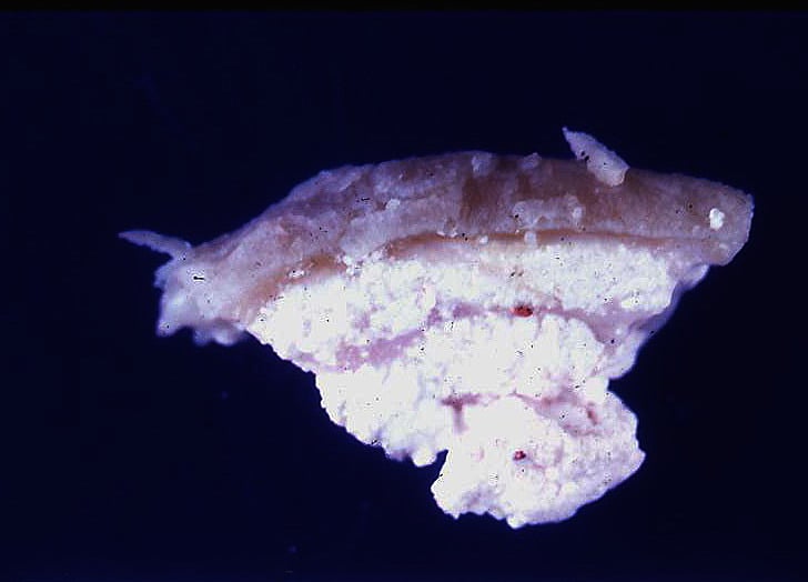 Gross pathology specimen of a gouty tophus showing chalky white urate crystal deposits