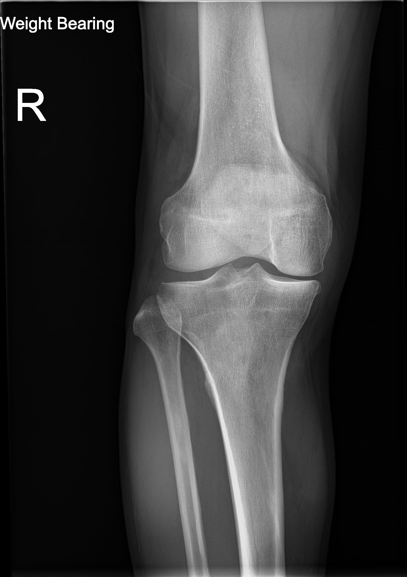 Weight-bearing AP radiograph of the knee, the correct technique for assessing joint-space loss in osteoarthritis
