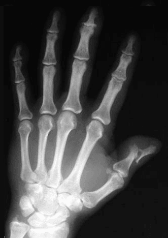 Hand radiograph showing DIP-predominant erosive changes consistent with psoriatic arthritis