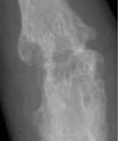 Radiograph of a wrist with advanced rheumatoid arthritis showing carpal destruction, erosions and joint-space loss
