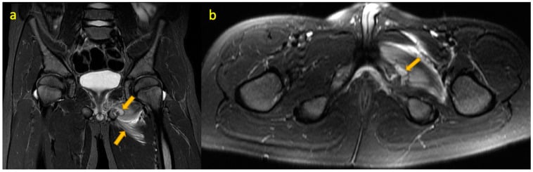 Coronal STIR and axial T2 MRI of pediatric septic arthritis demonstrating joint effusion