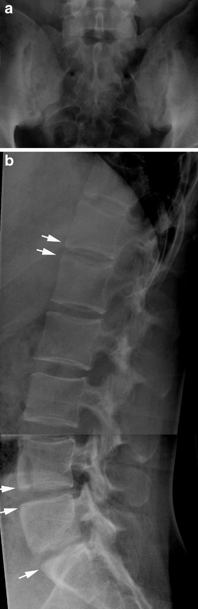AP pelvic and lateral lumbar radiographs demonstrating sacroiliitis in ankylosing spondylitis