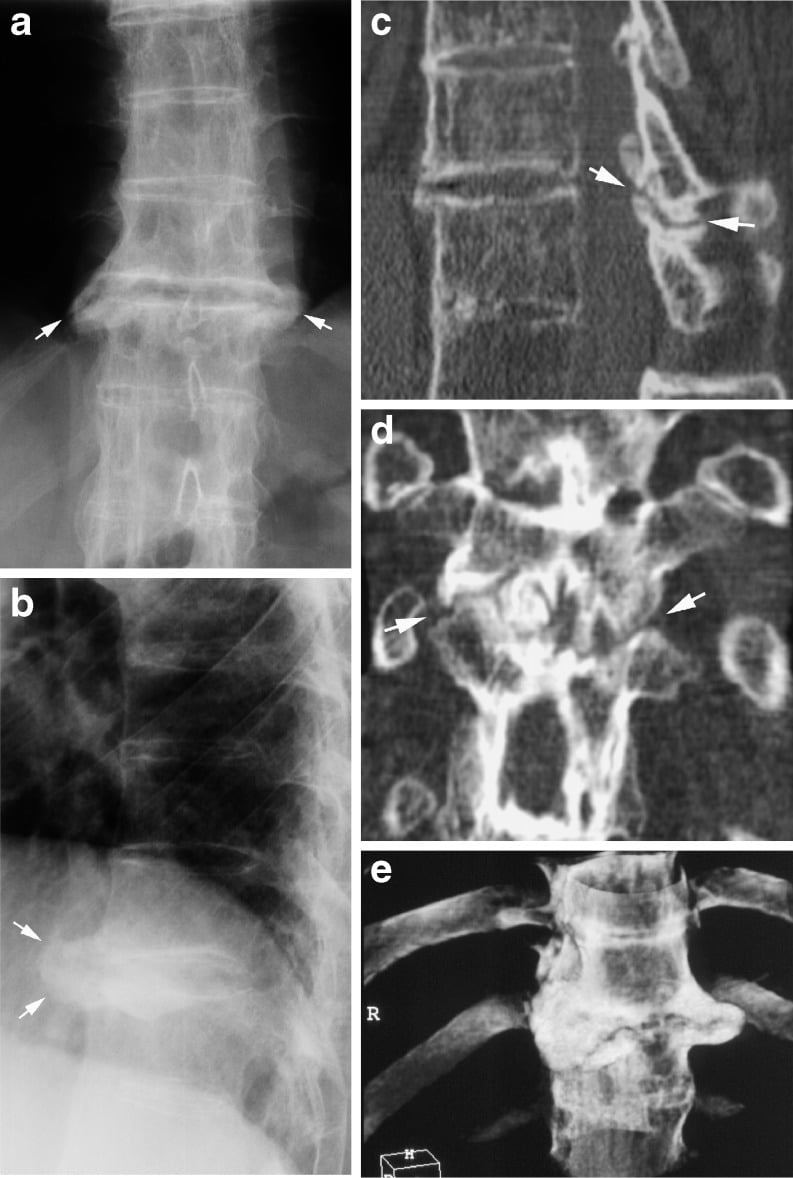 AP and lateral radiographs of bamboo spine in advanced ankylosing spondylitis