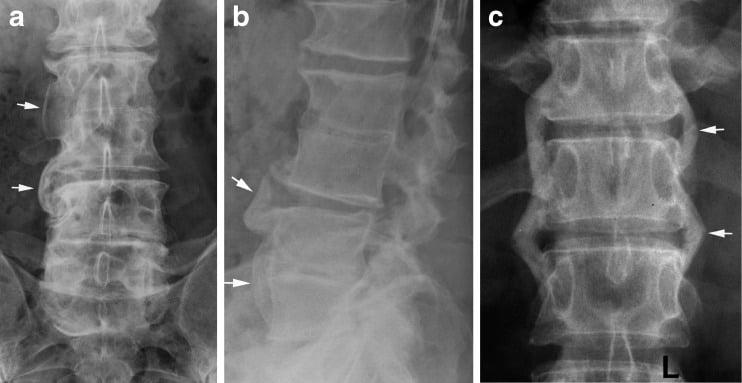 AP and lateral lumbar radiographs demonstrating coarse paravertebral ossifications in psoriatic arthritis