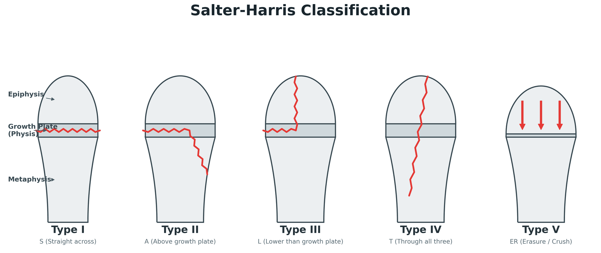 Salter-Harris classification of growth-plate (physeal) fractures, types I to V