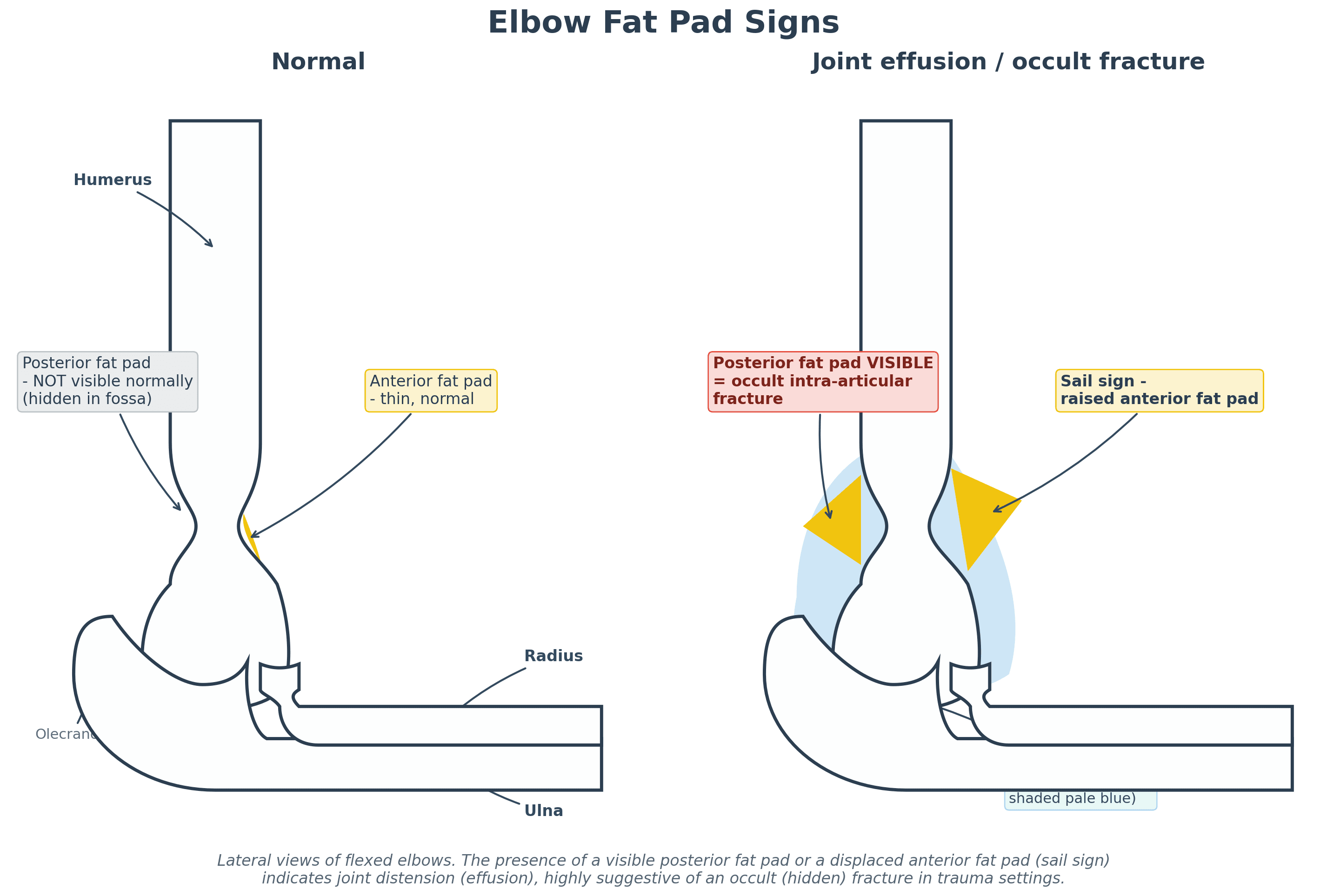 Diagram of elbow fat pad signs comparing the normal elbow with a joint effusion (sail sign and visible posterior fat pad)