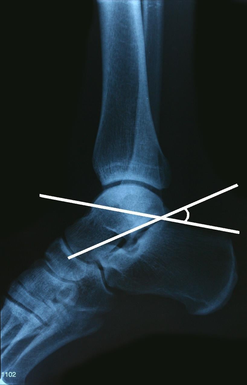 Boehler angle measurement on lateral calcaneal radiograph