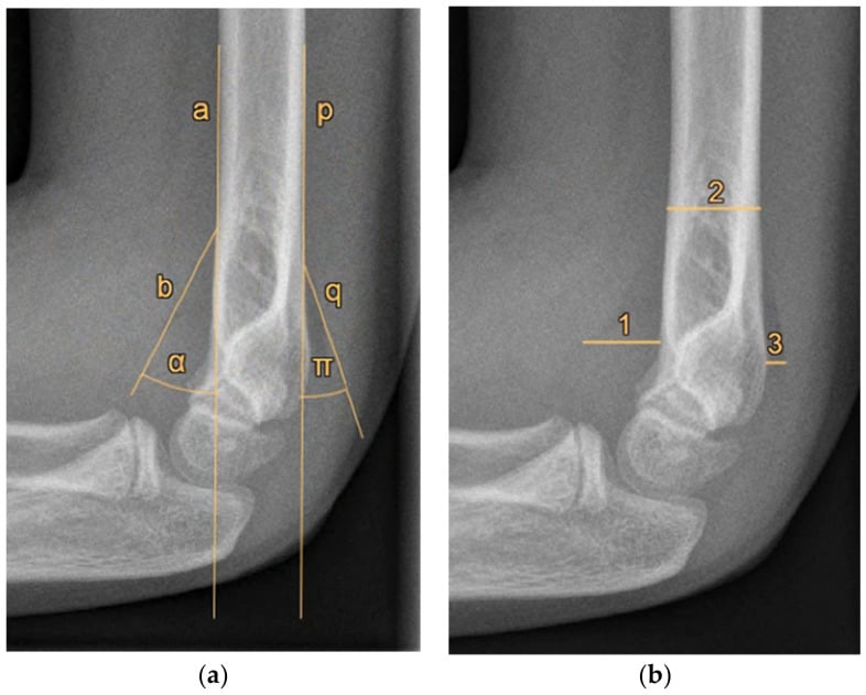 Lateral elbow radiograph demonstrating anterior and posterior fat pad displacement