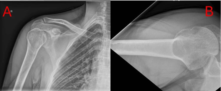 Anteroposterior and axillary radiographs showing lightbulb sign and trough sign in posterior shoulder dislocation