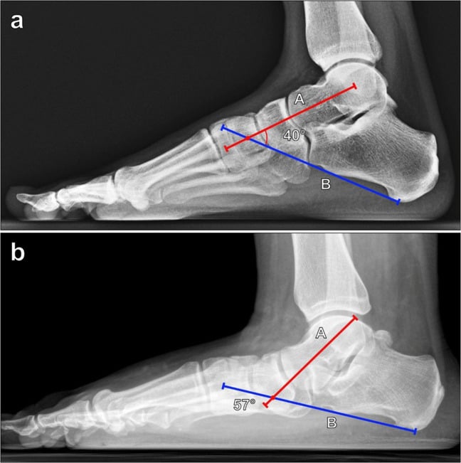 Lateral foot radiograph showing measurement of Bohler's angle and calcaneal geometry