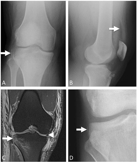 AP and lateral knee radiographs showing a Segond fracture and lipohemarthrosis