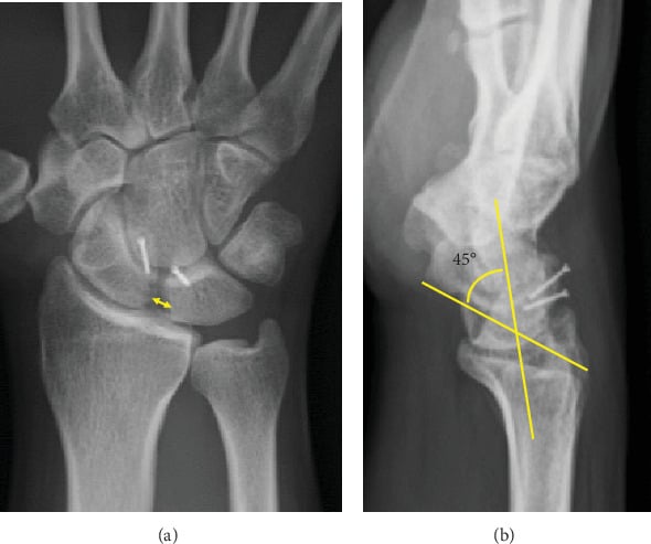 Posteroanterior wrist radiograph showing scapholunate interval measurement