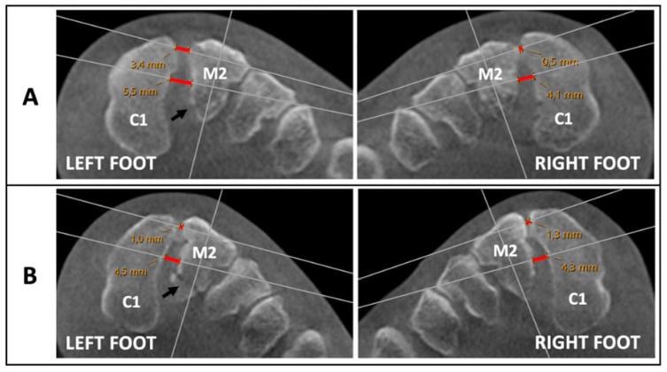 Weightbearing axial CT images evaluating subtle Lisfranc joint diastasis