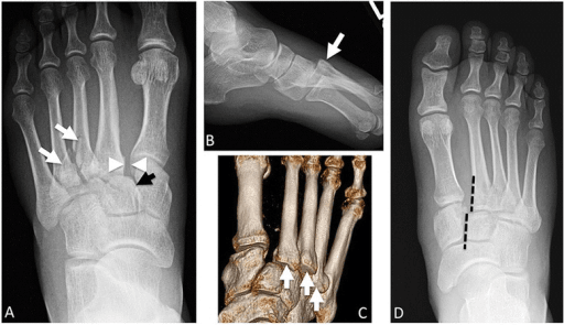 Anteroposterior radiograph demonstrating Lisfranc fracture-dislocation with fleck sign